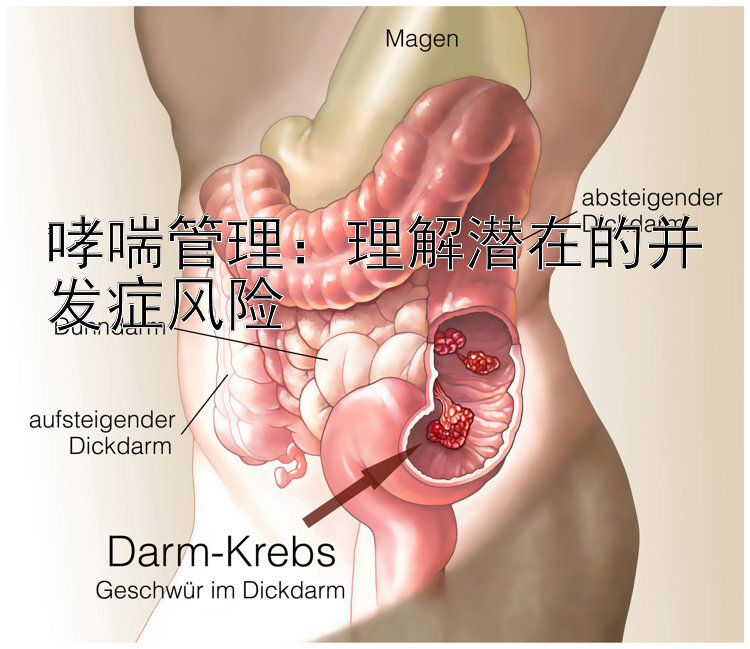 哮喘管理：理解潜在的并发症风险