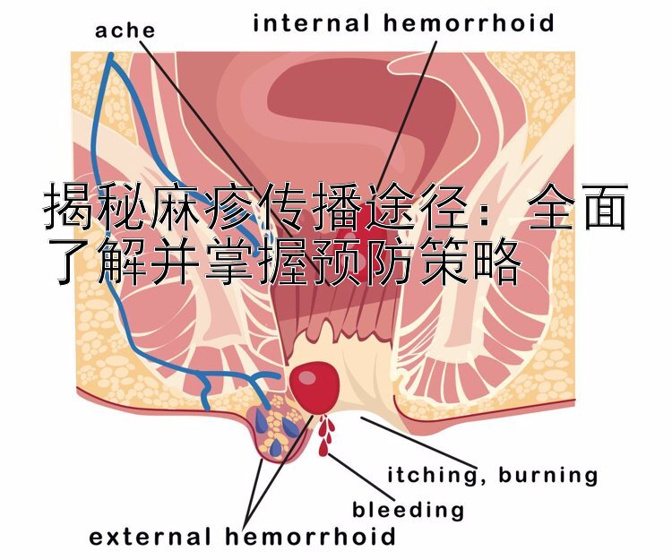 揭秘麻疹传播途径：全面了解并掌握预防策略