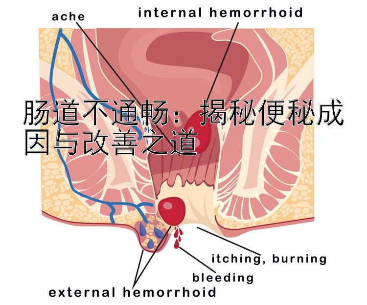 肠道不通畅：揭秘便秘成因与改善之道