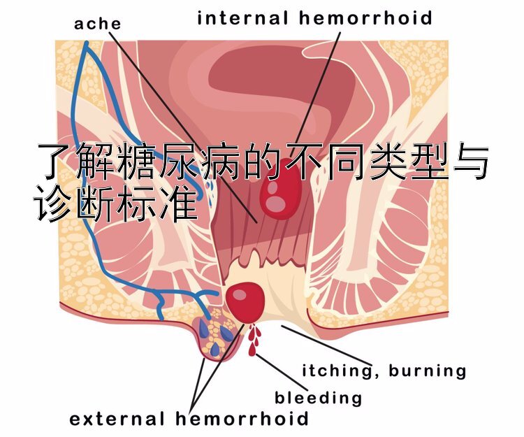 了解糖尿病的不同类型与诊断标准