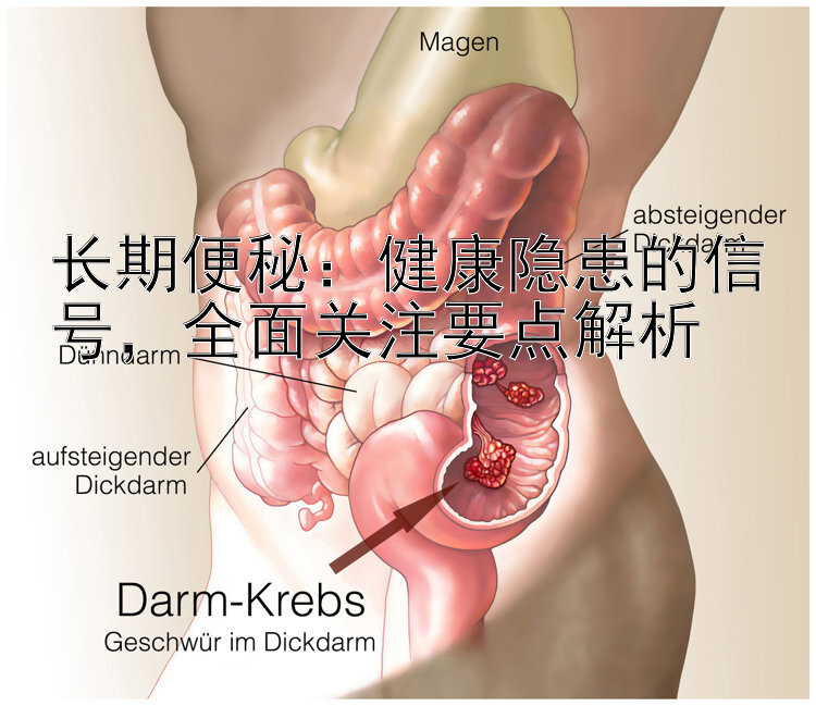 长期便秘：健康隐患的信号，全面关注要点解析