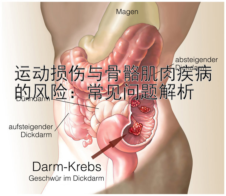 运动损伤与骨骼肌肉疾病的风险：常见问题解析