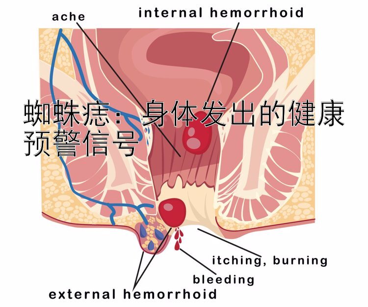 蜘蛛痣：身体发出的健康预警信号