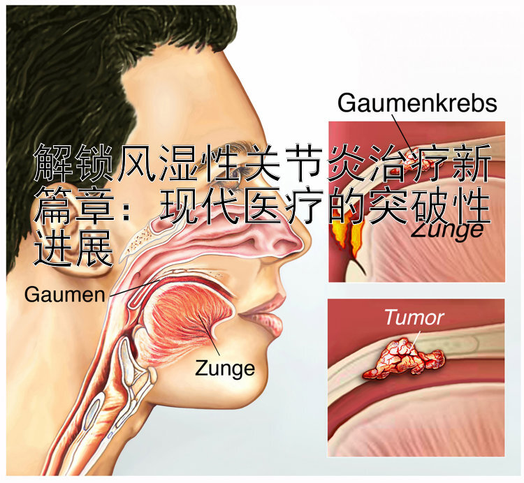 解锁风湿性关节炎治疗新篇章：现代医疗的突破性进展