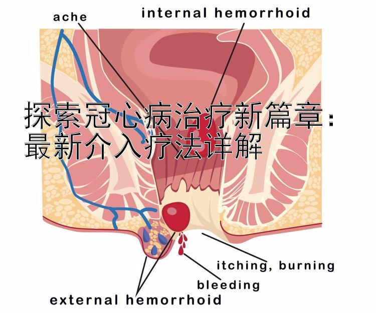 探索冠心病治疗新篇章：最新介入疗法详解