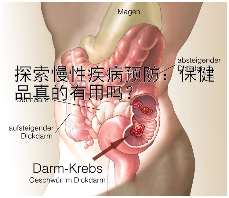 探索慢性疾病预防：保健品真的有用吗？