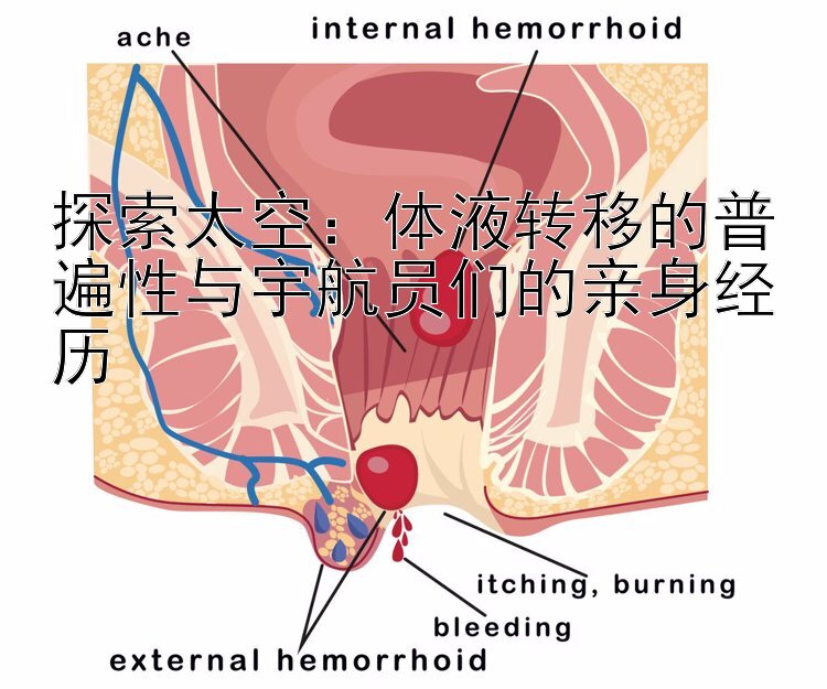 探索太空：体液转移的普遍性与宇航员们的亲身经历