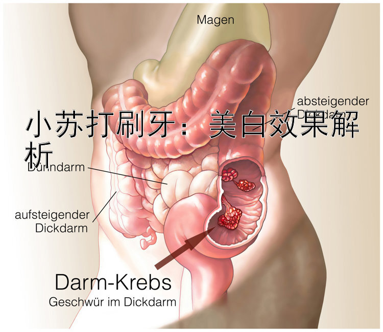 小苏打刷牙：美白效果解析