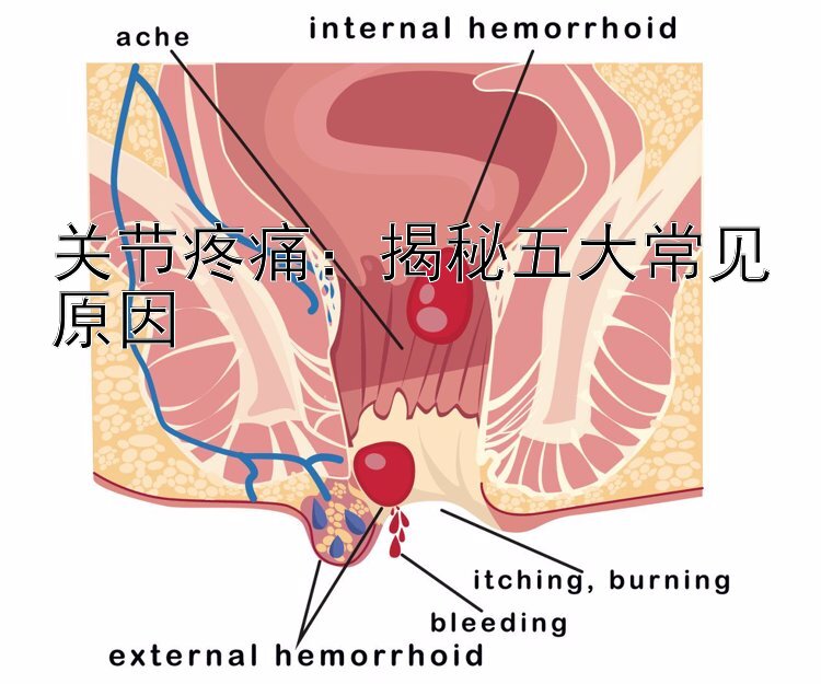 关节疼痛：揭秘五大常见原因