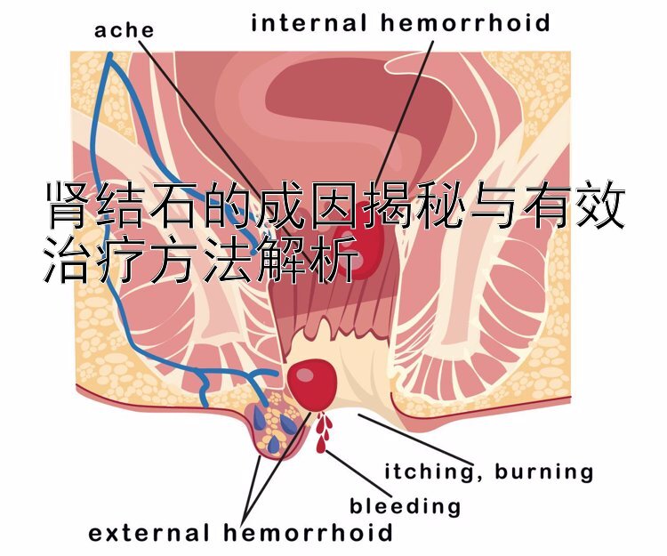 肾结石的成因揭秘与有效治疗方法解析