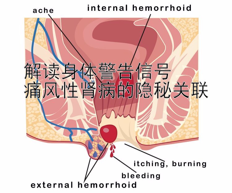 解读身体警告信号  
痛风性肾病的隐秘关联