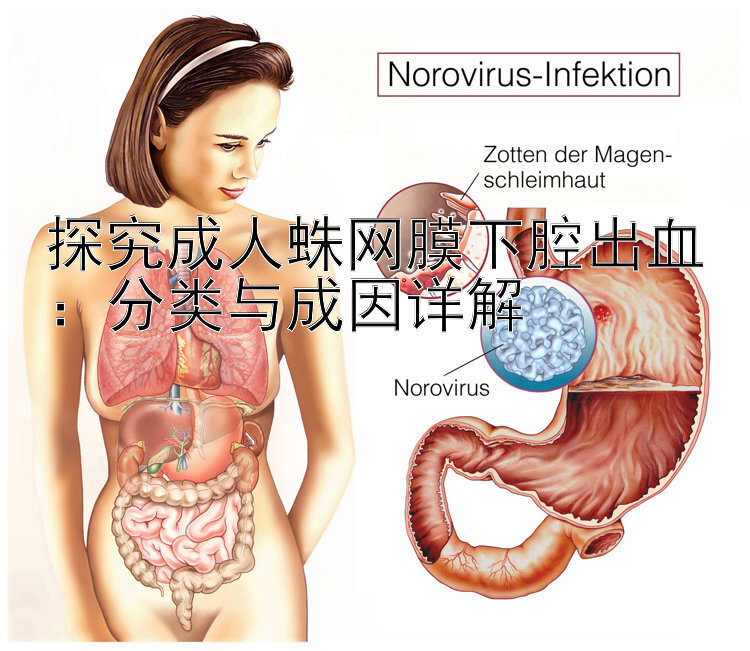 探究成人蛛网膜下腔出血：分类与成因详解