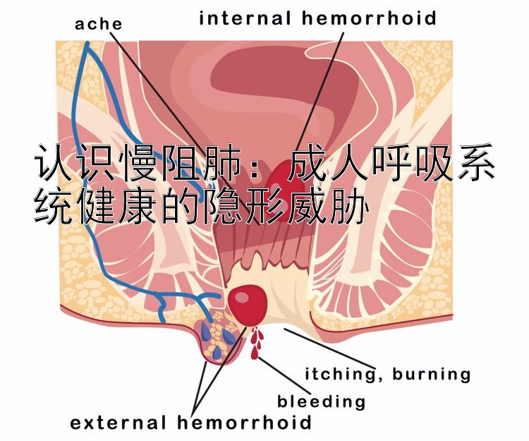 认识慢阻肺：成人呼吸系统健康的隐形威胁